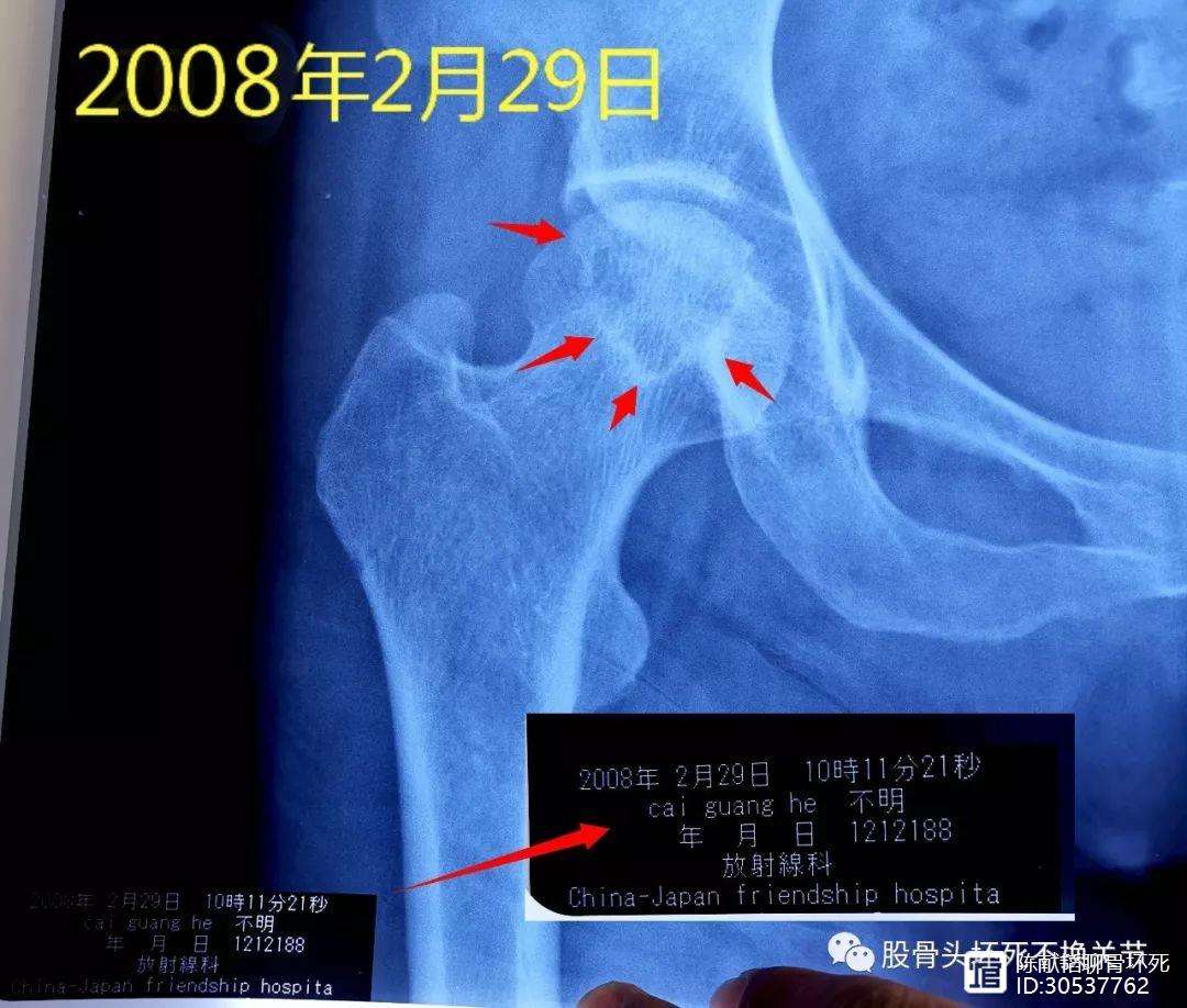 白银人工骨头医保报销多少(人工骨头医保报销多少比例)
